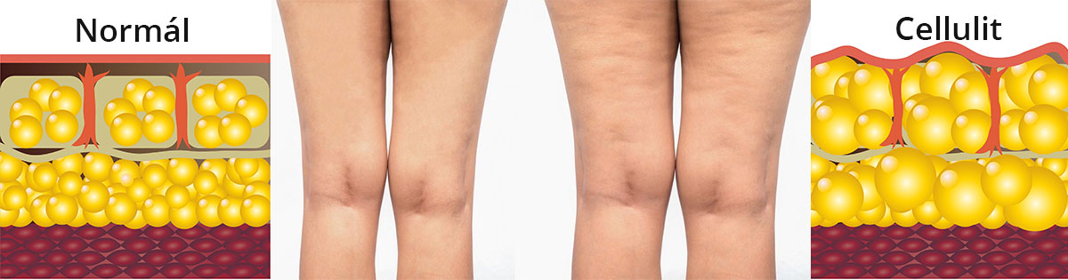 narancsbőr cellulit