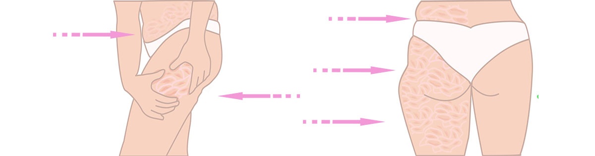 narancsbőr has, derék, külső és belső comb, fenék