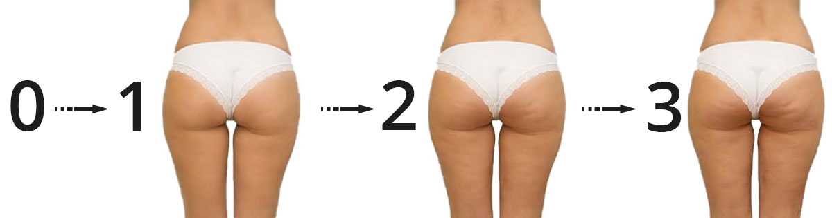 Narancsbőr fokai cellulit mértéke